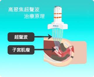 HIFUPRO – 無創治療子宮肌瘤的先進技術